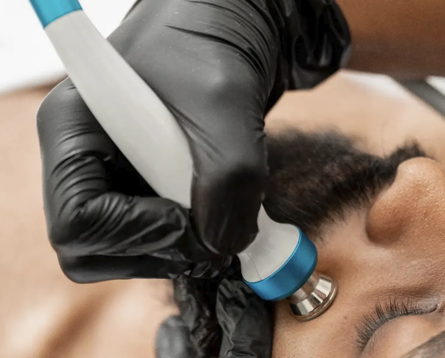 treatment for ingrown hairs beard exfoliation
